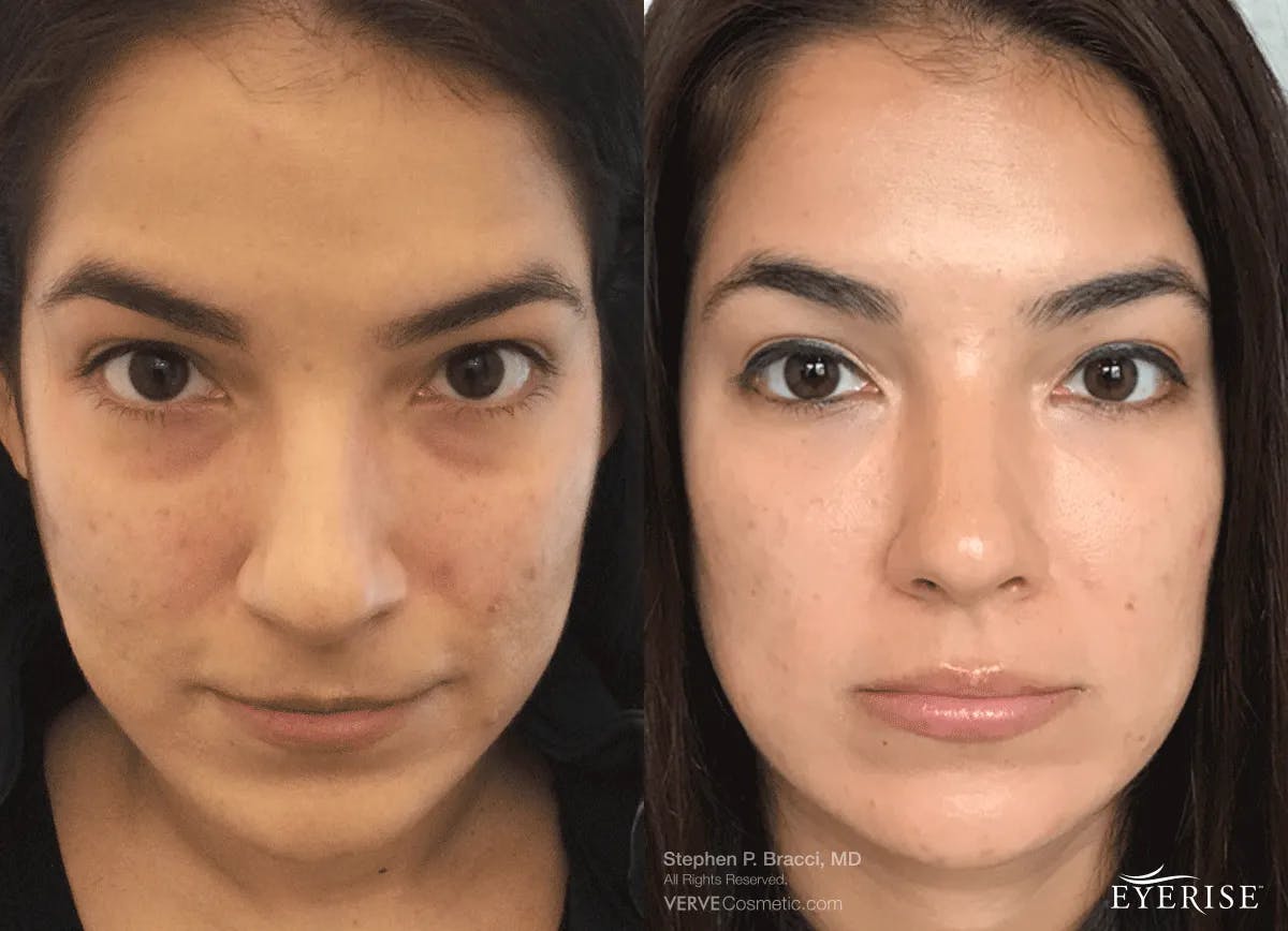 Eyerise™ Before & After Gallery - Patient 950242 - Image 1