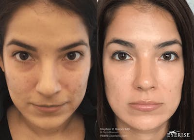 Eyerise™ Before & After Gallery - Patient 950242 - Image 1