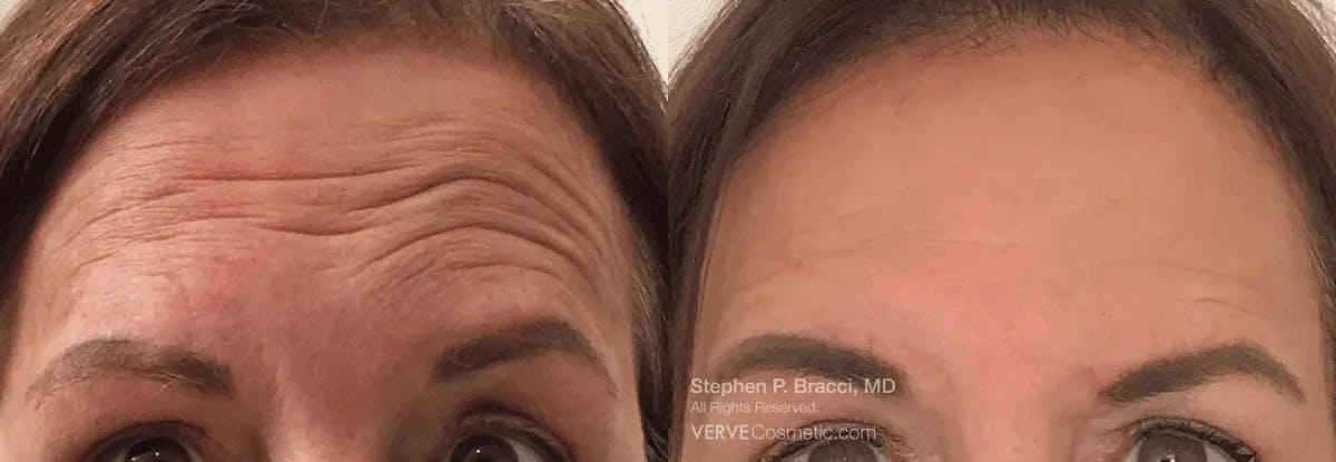 Forehead Line (Botox) Before & After Gallery - Patient 200659 - Image 1