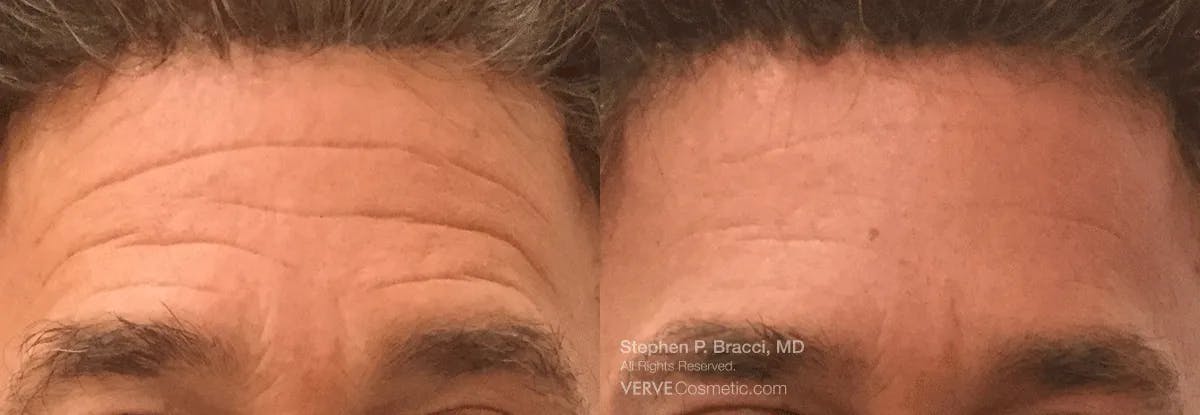 Forehead Line (Botox) Before & After Gallery - Patient 397202 - Image 1