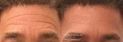 Forehead Line (Botox) Before & After Gallery - Patient 397202 - Image 1