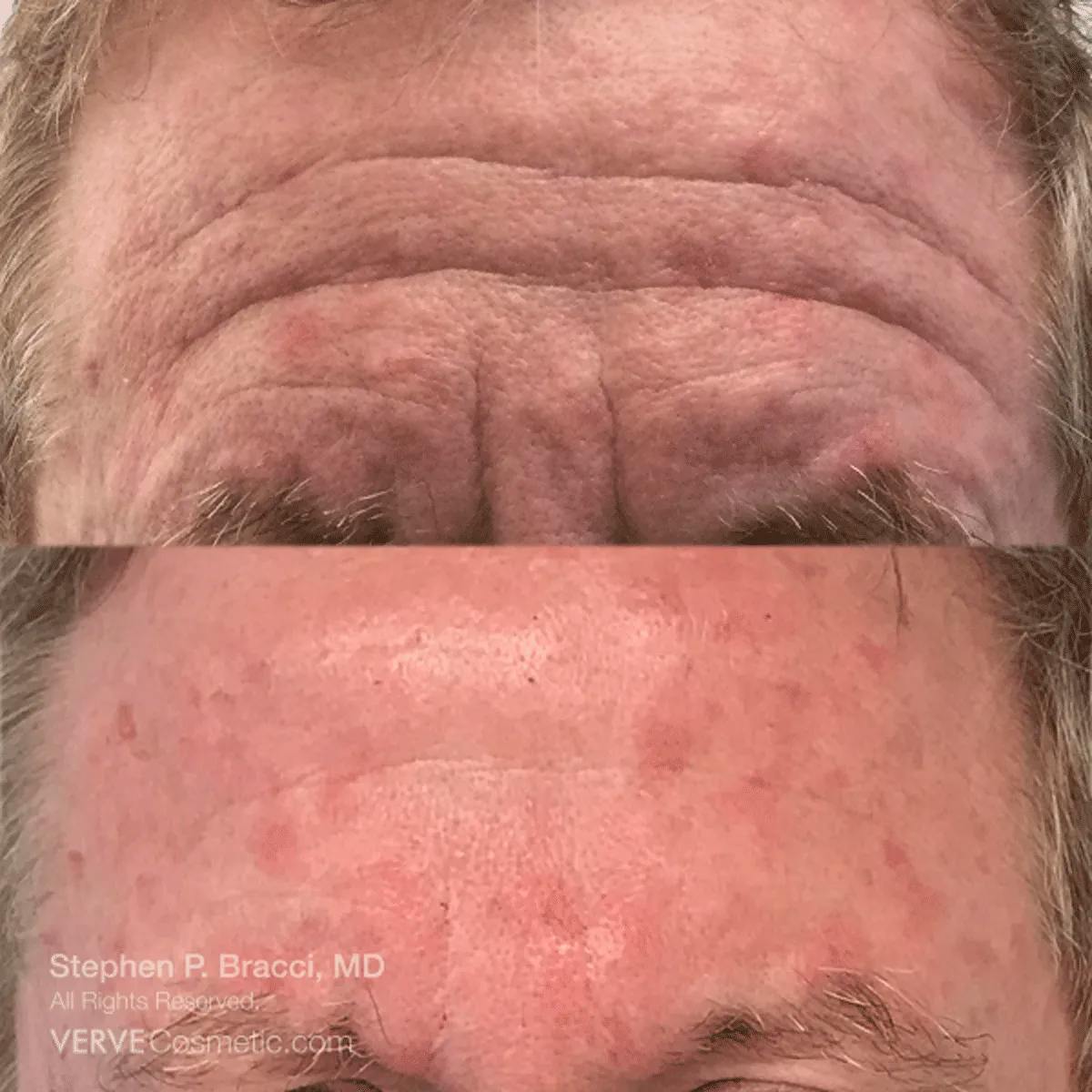 Forehead Line (Botox) Before & After Gallery - Patient 394972 - Image 1