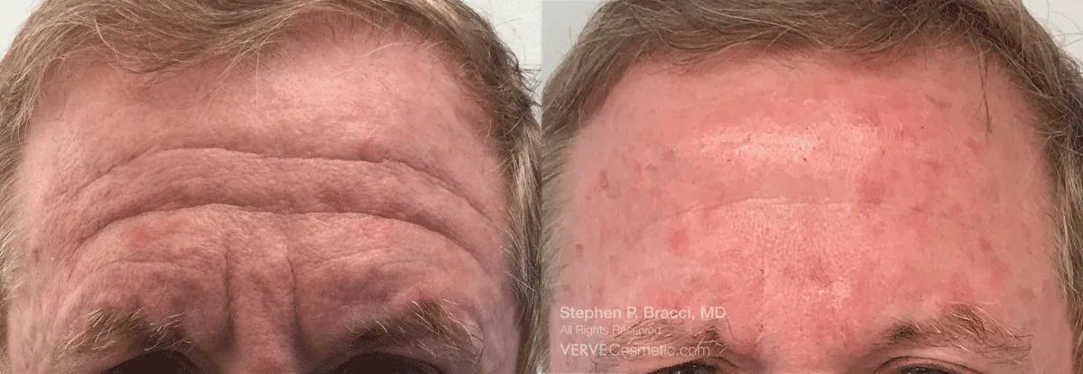 Forehead Line (Botox) Before & After Gallery - Patient 394972 - Image 2