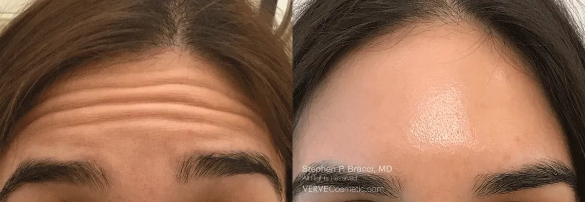 Forehead Line (Botox) Before & After Gallery - Patient 186482 - Image 1