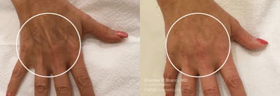 Hands (Radiesse) Before & After Gallery - Patient 614060 - Image 1