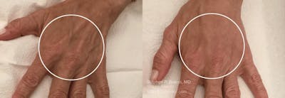 Hands (Radiesse) Before & After Gallery - Patient 277934 - Image 1