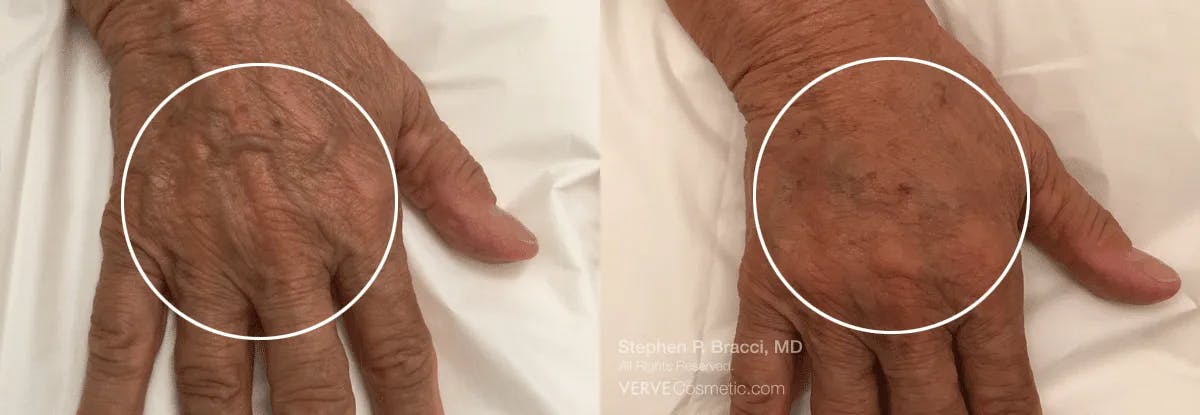 Hands (Radiesse) Before & After Gallery - Patient 101391 - Image 1
