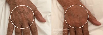 Hands (Radiesse) Before & After Gallery - Patient 101391 - Image 1