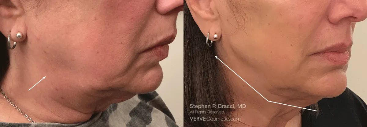 Jawline Area (Chin) Contouring Before & After Gallery - Patient 160846 - Image 1