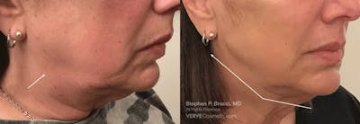 Jawline Area (Chin) Contouring Before & After Gallery - Patient 160846 - Image 1