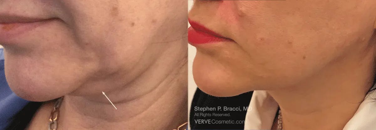 Jawline Area (Chin) Contouring Before & After Gallery - Patient 387643 - Image 1
