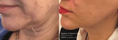 Jawline Area (Chin) Contouring Before & After Gallery - Patient 387643 - Image 1
