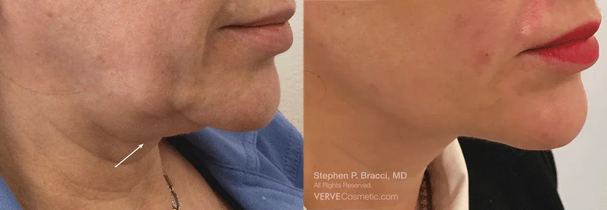 Jawline Area (Chin) Contouring Before & After Gallery - Patient 387643 - Image 2