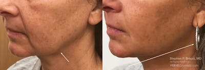 Jawline Area (Chin) Contouring Before & After Gallery - Patient 138203 - Image 1