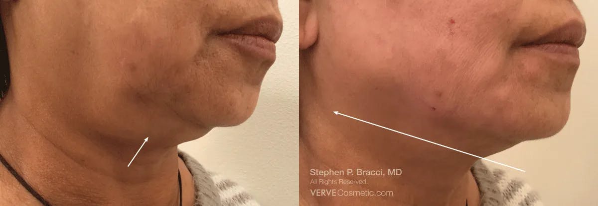 Jawline Area (Chin) Contouring Before & After Gallery - Patient 347633 - Image 1