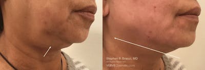 Jawline Area (Chin) Contouring Before & After Gallery - Patient 347633 - Image 1