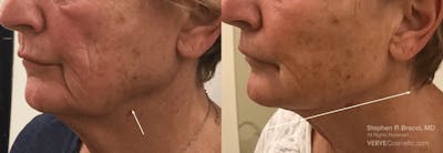 Jawline Area (Chin) Contouring Before & After Gallery - Patient 103733 - Image 1