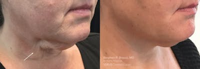 Jawline Area (Chin) Contouring Before & After Gallery - Patient 409133 - Image 1