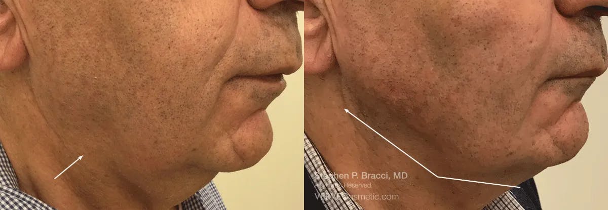 Jawline Area (Chin) Contouring Before & After Gallery - Patient 290665 - Image 1