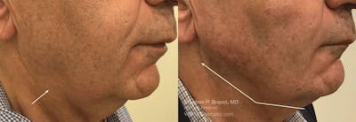 Jawline Area (Chin) Contouring Before & After Gallery - Patient 290665 - Image 1