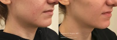 Jawline Area (Chin) Contouring Before & After Gallery - Patient 393624 - Image 1