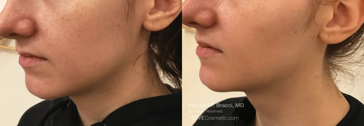 Jawline Area (Chin) Contouring Before & After Gallery - Patient 393624 - Image 2