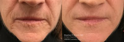 Lip Lines Before & After Gallery - Patient 220238 - Image 1