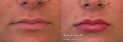 Lips Before & After Gallery - Patient 260724 - Image 1