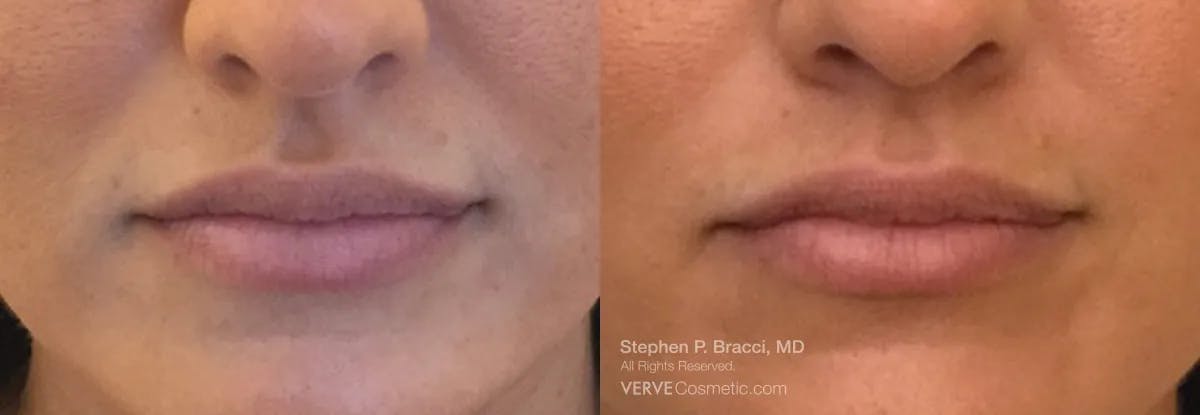 Lips Before & After Gallery - Patient 282091 - Image 1