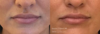 Lips Before & After Gallery - Patient 282091 - Image 1