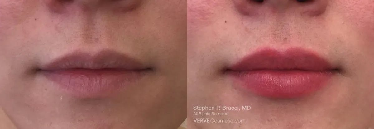 Lips Before & After Gallery - Patient 423750 - Image 1