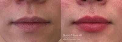 Lips Before & After Gallery - Patient 423750 - Image 1