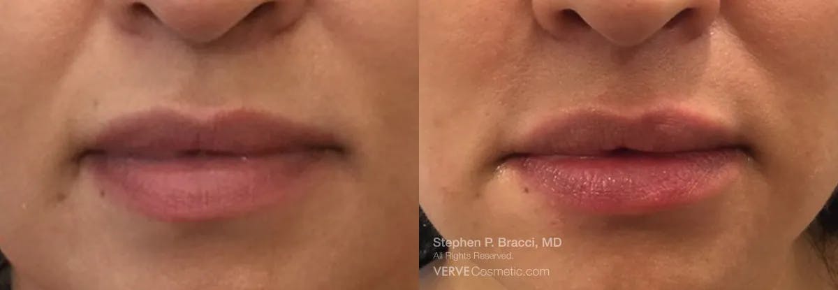 Lips Before & After Gallery - Patient 238425 - Image 1