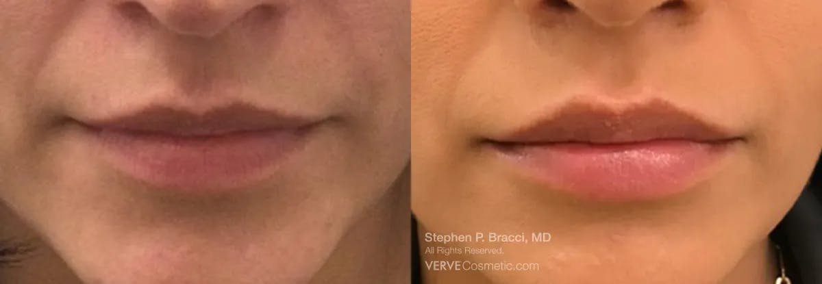 Lips Before & After Gallery - Patient 385161 - Image 1