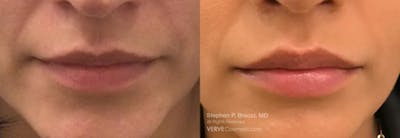 Lips Before & After Gallery - Patient 385161 - Image 1