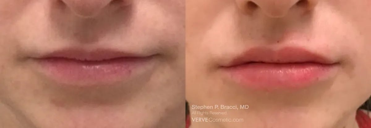 Lips Before & After Gallery - Patient 286972 - Image 1