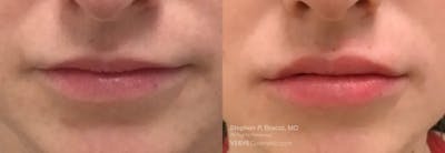 Lips Before & After Gallery - Patient 286972 - Image 1