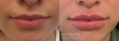 Lips Before & After Gallery - Patient 260321 - Image 1
