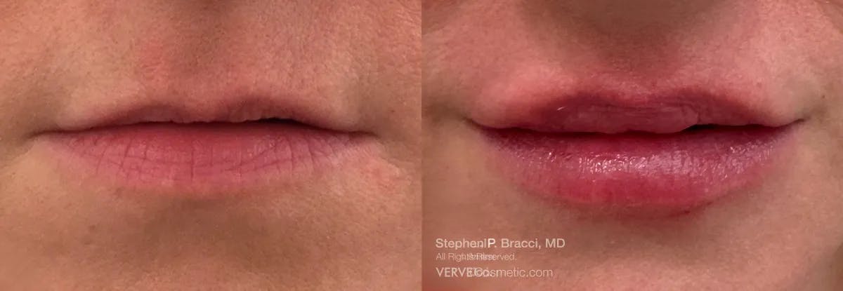Lips Before & After Gallery - Patient 578833 - Image 1