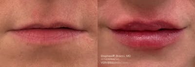 Lips Before & After Gallery - Patient 578833 - Image 1