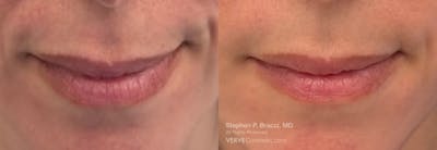 Lips Before & After Gallery - Patient 377256 - Image 1