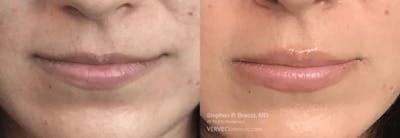 Lips Before & After Gallery - Patient 281827 - Image 1