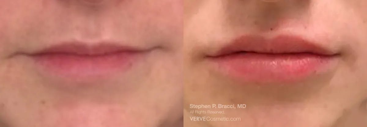 Lips Before & After Gallery - Patient 396754 - Image 1