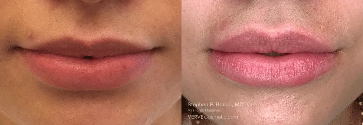 Lips Before & After Gallery - Patient 214884 - Image 1