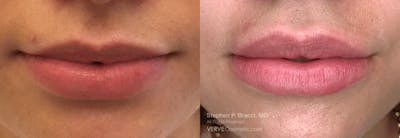 Lips Before & After Gallery - Patient 214884 - Image 1