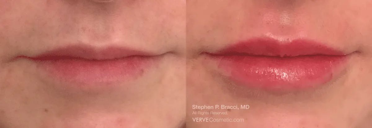 Lips Before & After Gallery - Patient 297364 - Image 1