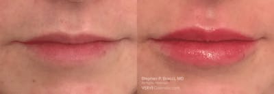 Lips Before & After Gallery - Patient 297364 - Image 1