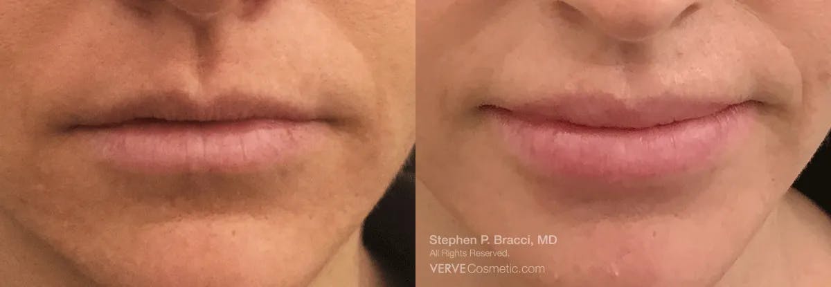 Lips Before & After Gallery - Patient 180229 - Image 1