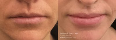 Lips Before & After Gallery - Patient 180229 - Image 1