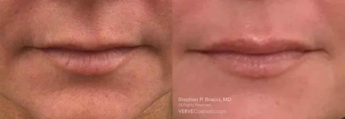 Lips Before & After Gallery - Patient 400676 - Image 1